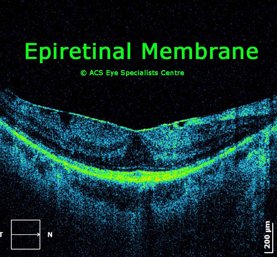 ACS Eye Specialists OCT Optical Coherence Tomography 